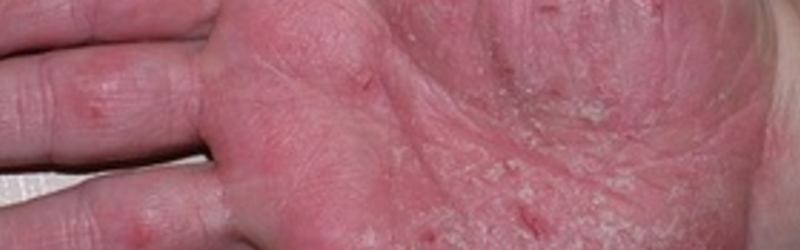 Hand eczema fill 1632x510