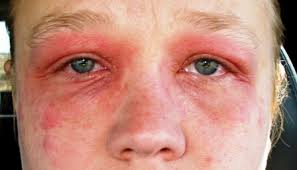 Eyelid eczema – Allergy