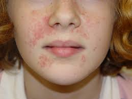 Perioral eczema