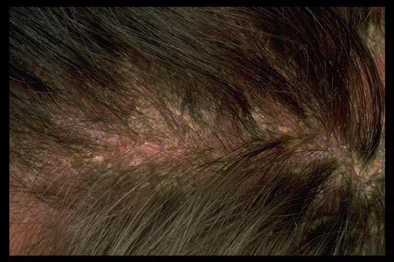 Scalp cradle shop cap in adults