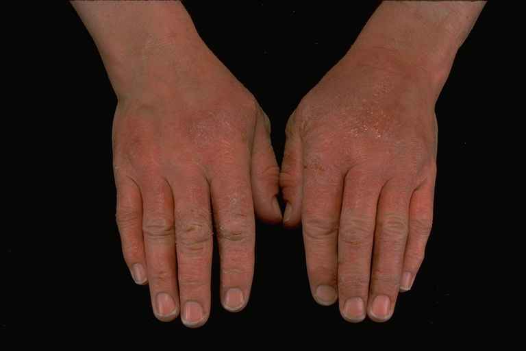 Contact dermatitis